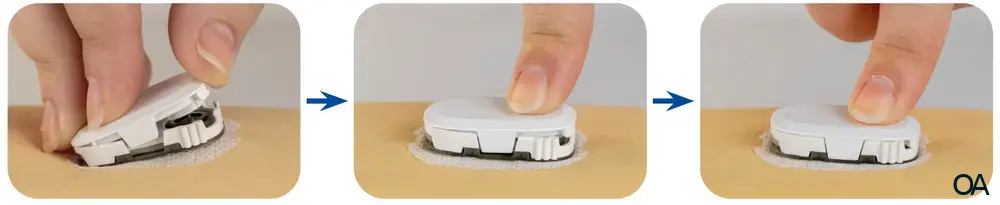 Wellion SENSOR Transmitter