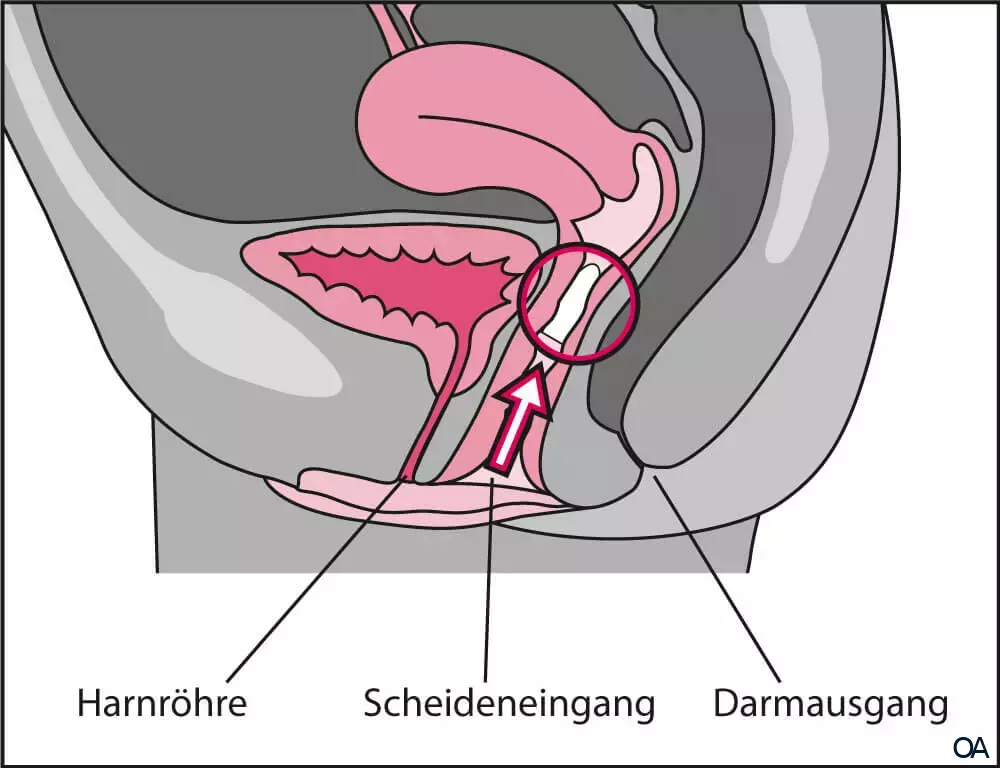 Vagisan FeuchtCreme Cremolum Zäpfchen Vagisan FeuchtCreme Cremolum Zäpfchen